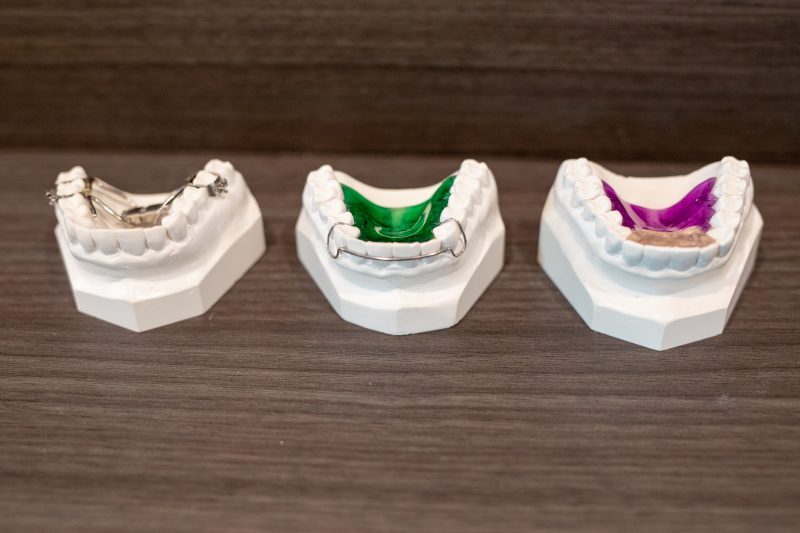 Three custom retainers shown on dental study models